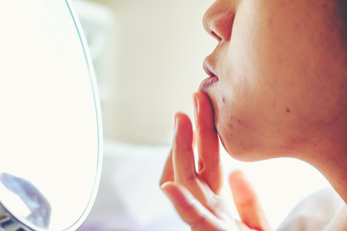 A woman looking at the bumps along her chin.